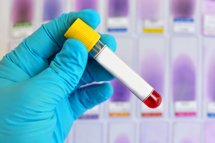 Alzheimer riskini ongoren yeni bir kan testi yolda tam olarak ne zaman hazir olacak I7DMNr2Y